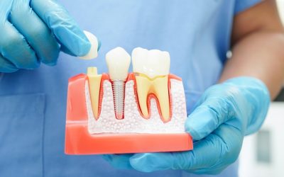 What Questions Should I Ask a Dentist Before Getting Implants?