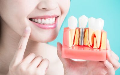 Who Can Benefit From Dental Implants the Most?