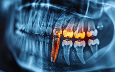 When Should I Consider Getting Dental Implants for Missing Teeth?