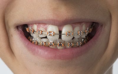 What Are the Most Common Orthodontic Issues?