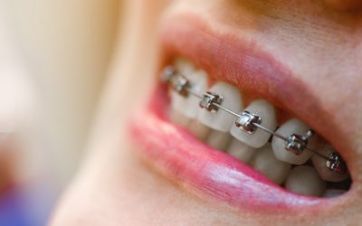 How to Maximize the Benefits of My Orthodontic Treatment?
