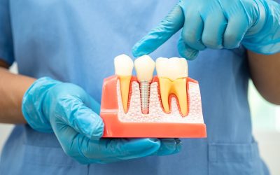 Why Should You Consider Dental Implants for Missing Teeth?