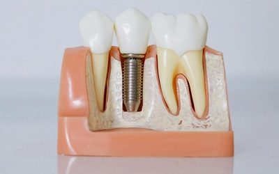 What Are the Long-Term Benefits and Success Rates of Dental Implants?