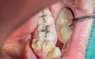 What Are the Common Dental Problems