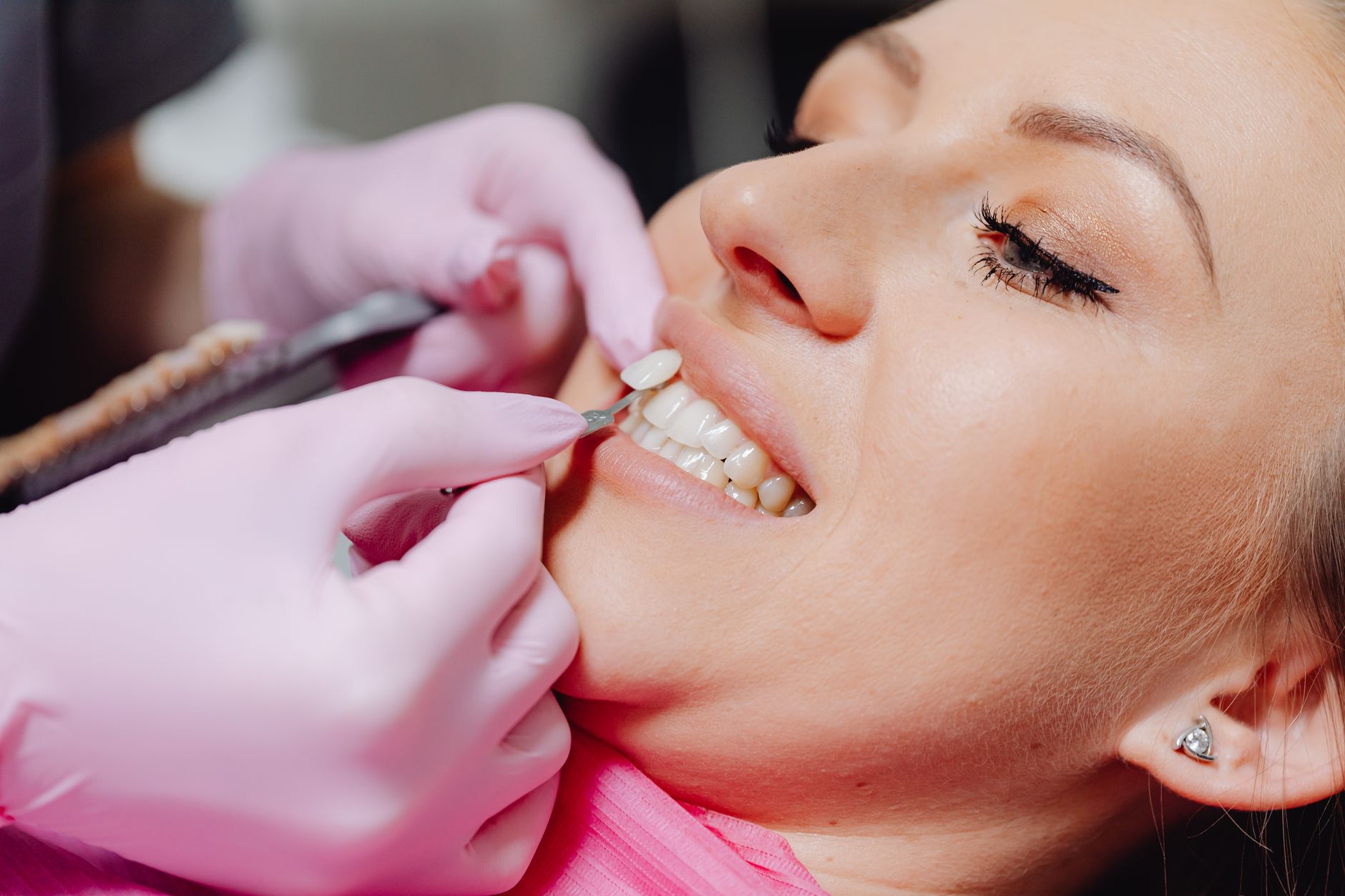 Veneers vs. Crowns: Understanding the Key Differences