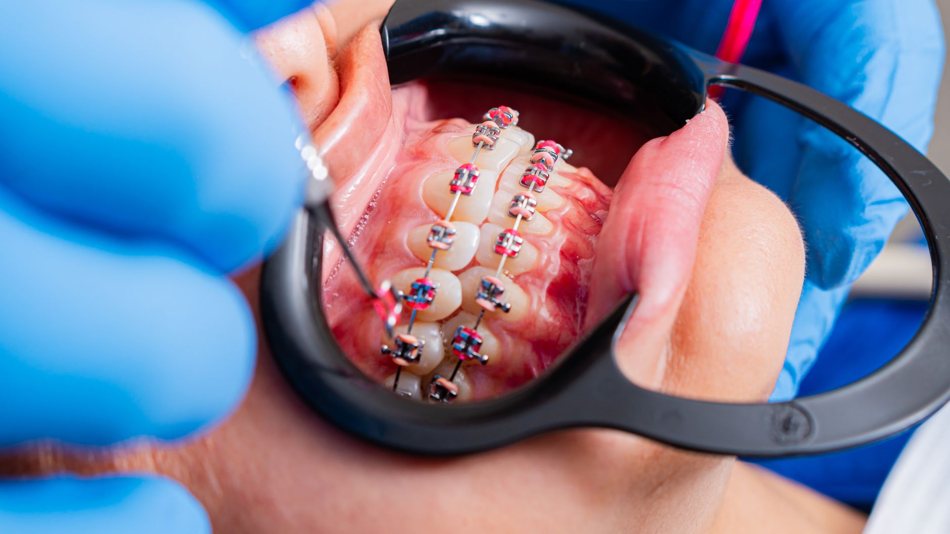 Caring for Your Teeth with Braces: Essential Tips