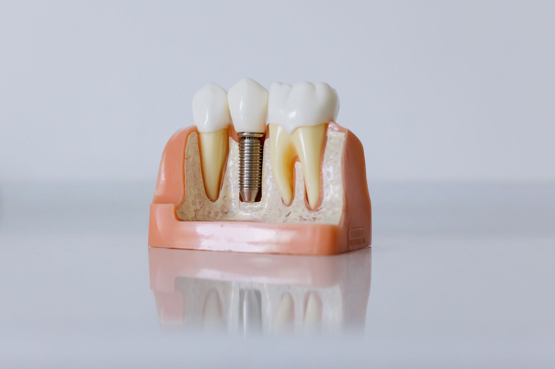 How to Prepare for Your Dental Implant Surgery