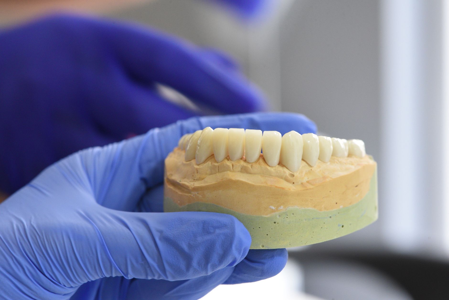 Discover the Benefits of Implant-Supported Teeth
