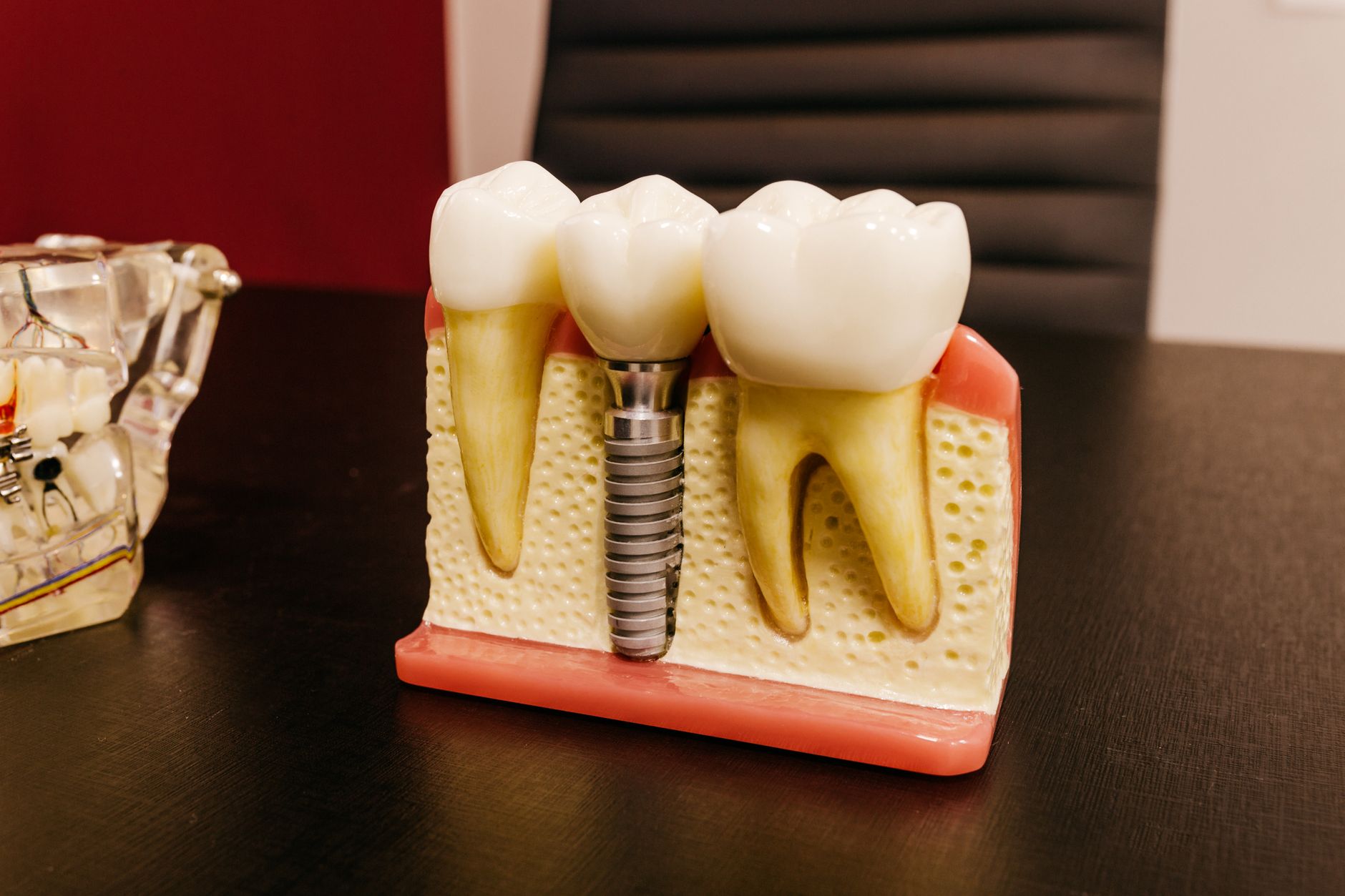 Exploring the Benefits of Dental Implants