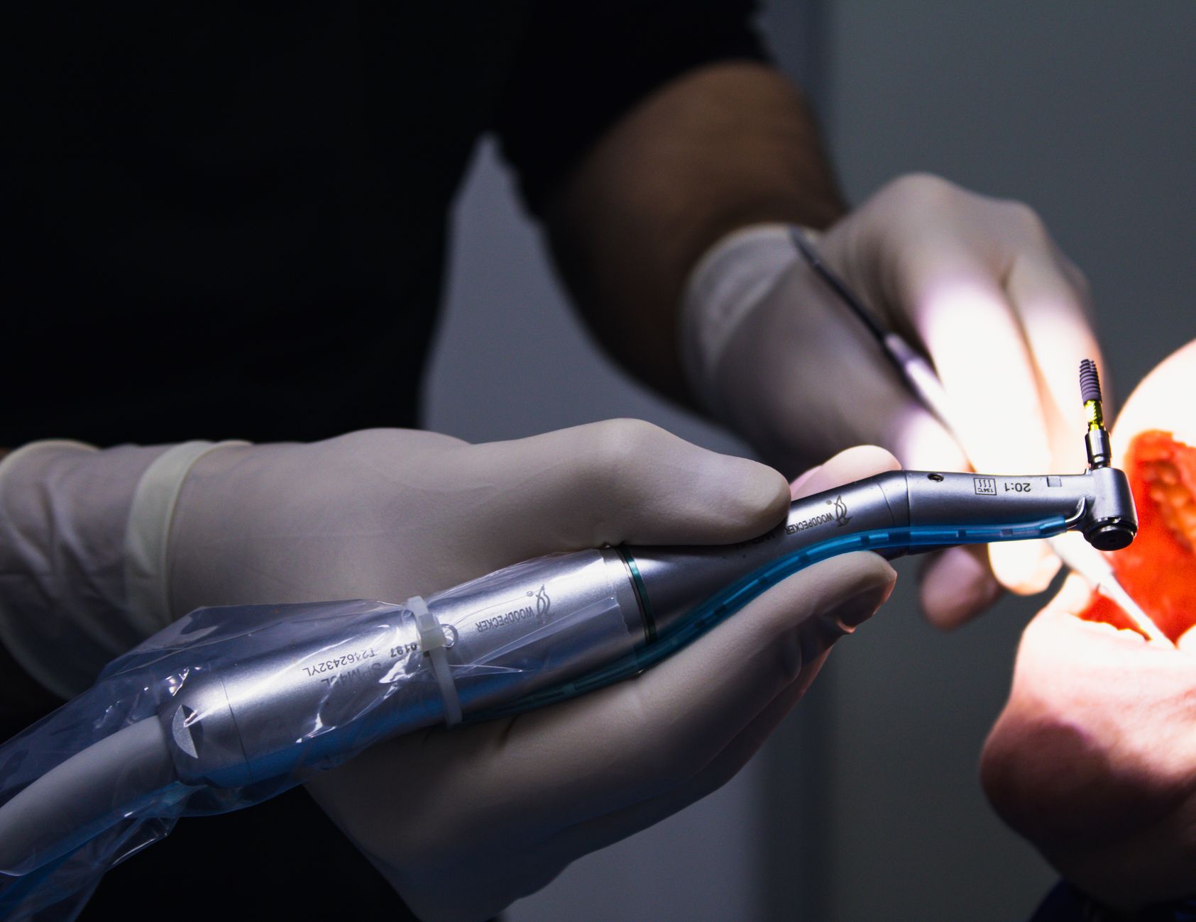 How Long Do Dental Fillings Last?